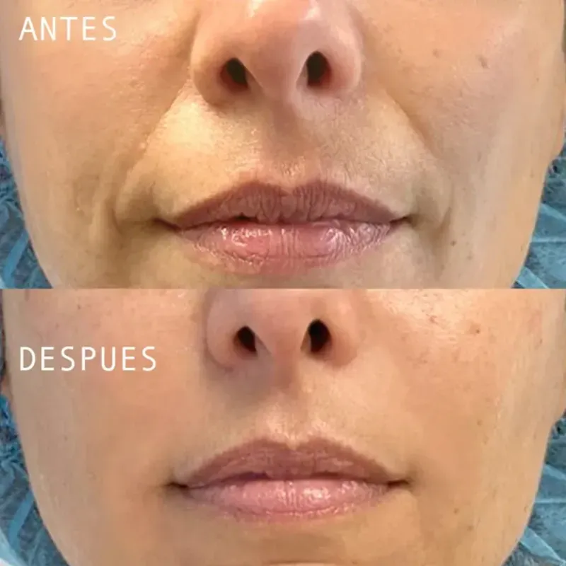Lifting facial
