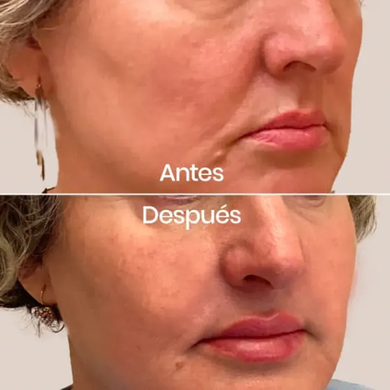 Lifting facial