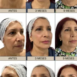 Lifting facial