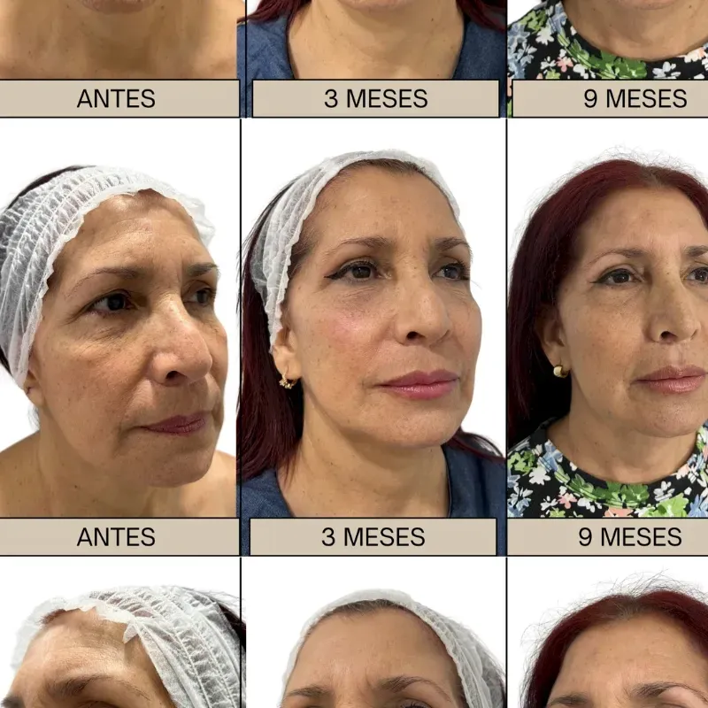 Lifting facial
