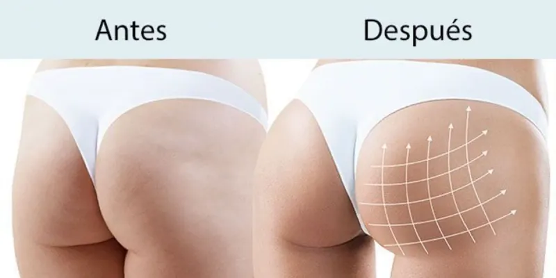 Proyección de glúteos 