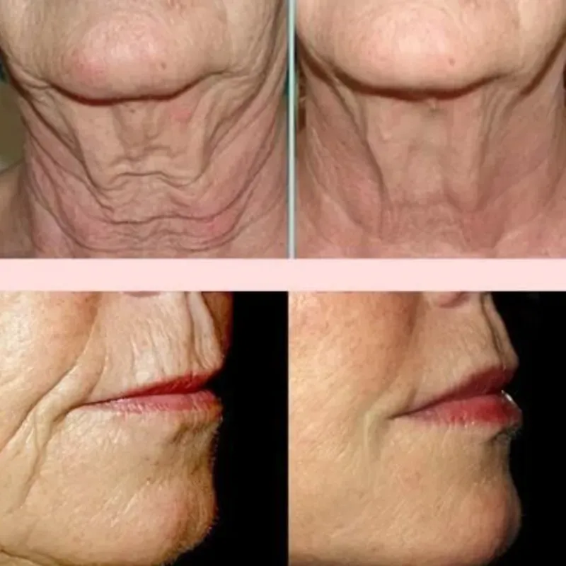 Radiofrecuencia facial 