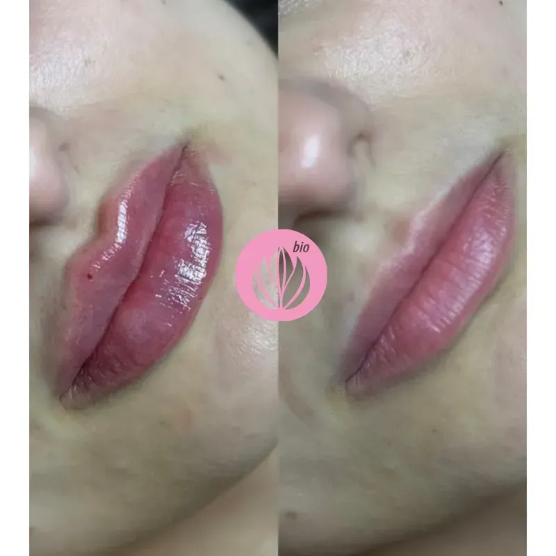 Relleno labial