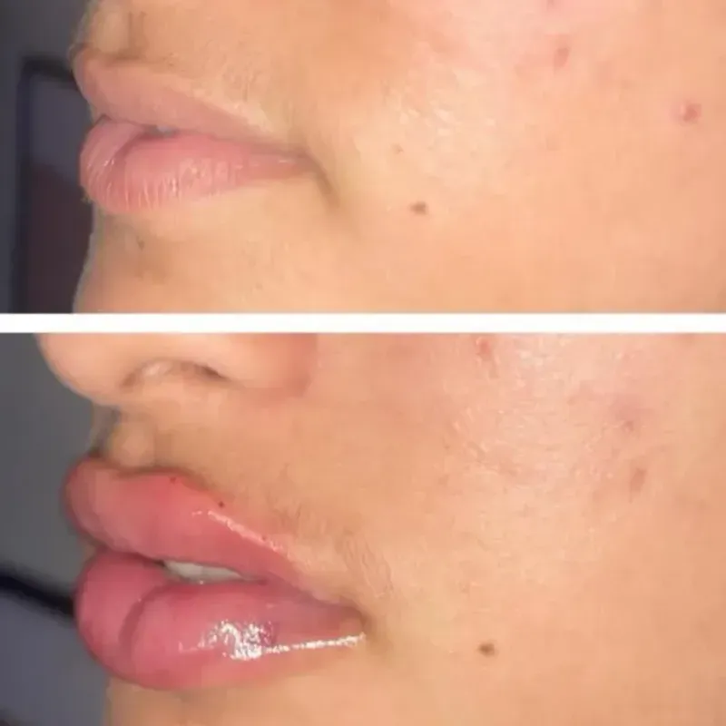 Relleno labial