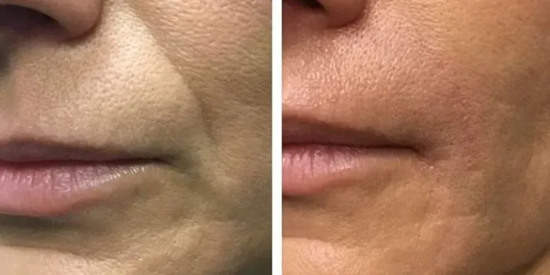 Renovación celular con FILLMED NCTF 135. HA