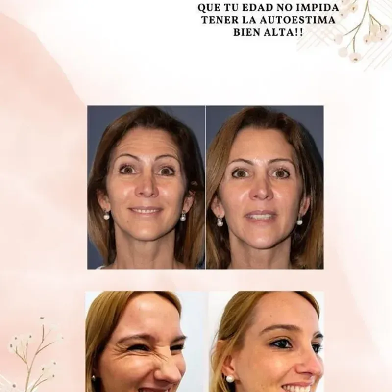 Toxina botulínica 