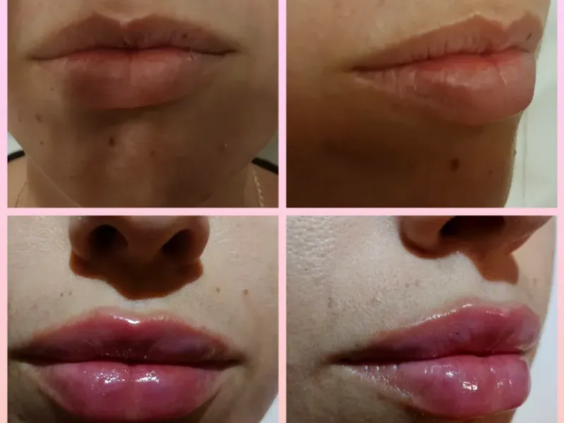 TRATAMIENTO LABIAL