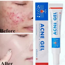 Tratamiento en gel para el acné 