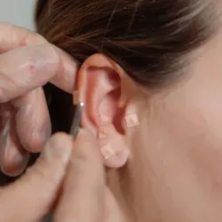 Auriculotherapy (20 min )