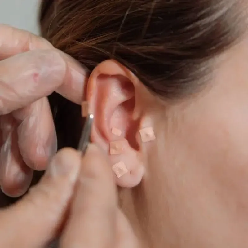 Auriculotherapy (20 min )