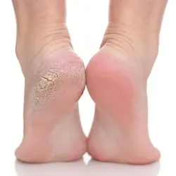 Anti callus treatment for feet