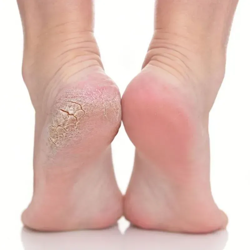 Anti callus treatment for feet