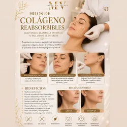 Tratamientos hilo de colageno
