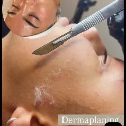 Dermaplaning