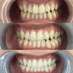 Blanqueamiento Dental Activado con luz Led con Peróxido de Carbamida
