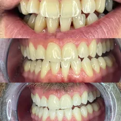 Blanqueamiento Dental con Peróxido de Hidrógeno (HP Whitness)
