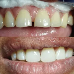 Cierre de Diastema