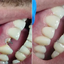Corona con Espiga en TPR Realizado