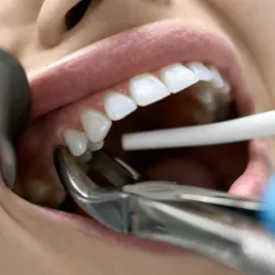 Exodoncias (Extracciones)