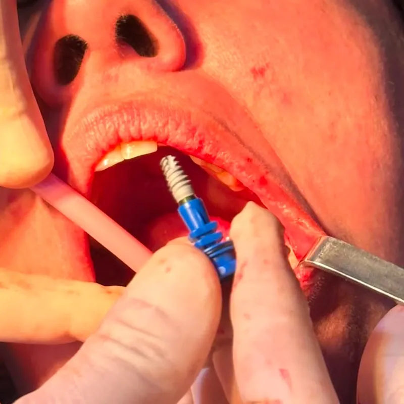 Implantes Dentales