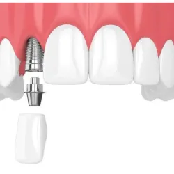 Implantes Dentales