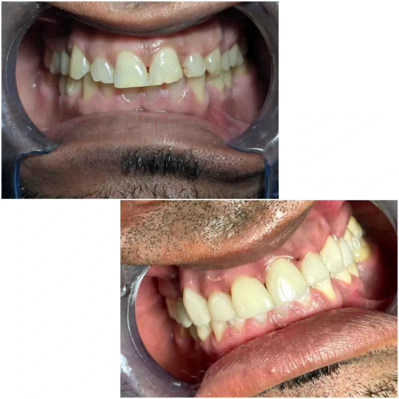 Microdiseño de sonrisa