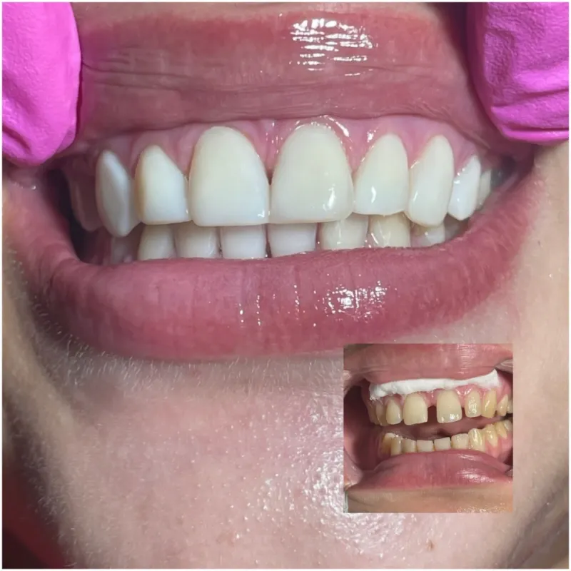 Microdiseño de sonrisa