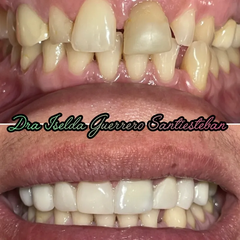 Microdiseño de sonrisa