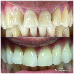 Microdiseño de sonrisa