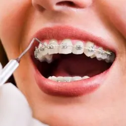 Profilaxis a Paciente con Braquets
