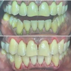 Profilaxis Dental