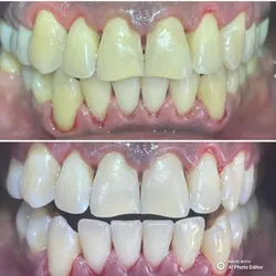 Profilaxis Dental