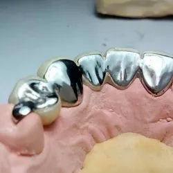 Prótesis Fija (Puente de Metal Acrílico)