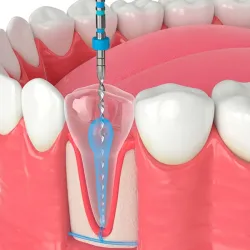 TPR ( endodoncia) 