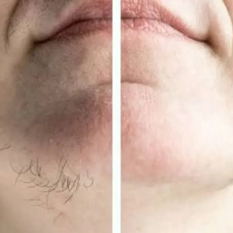 DEPILACIÓN DE BARBILLA CON CERA