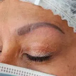 ELIMINACIÓN DE MICROPIGMENTACIÓN DE CEJAS 