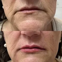 ELIMINACIÓN O DISMINUCIÓN DE SURCOS NASOGENIANOS Y PERIBUCALES 