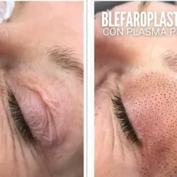 LEVANTAMIENTO DE PÁRPADOS SUPERIORES ( BLEFAROPLASTIA) 