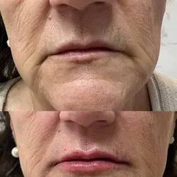 LIMPIEZA Y TRATAMIENTO FACIAL CON APARATOLOGIA COMPLETA 