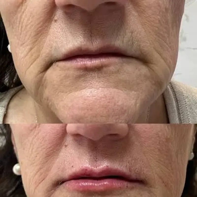 LIMPIEZA Y TRATAMIENTO FACIAL CON APARATOLOGIA COMPLETA