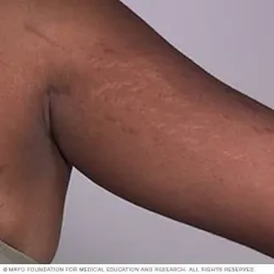 TRATAMIENTO DE ESTRÍAS EN BRAZOS 