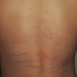 TRATAMIENTO DE ESTRÍAS EN ESPALDA 