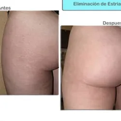 TRATAMIENTO DE ESTRÍAS EN GLÚTEOS 