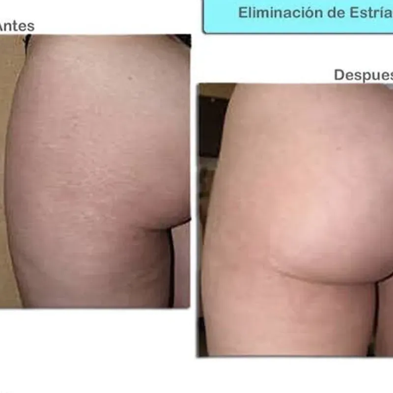 TRATAMIENTO DE ESTRÍAS EN GLÚTEOS 