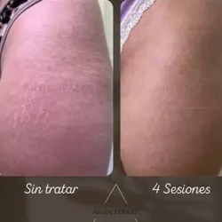 TRATAMIENTO DE ESTRÍAS EN MUSLOS 