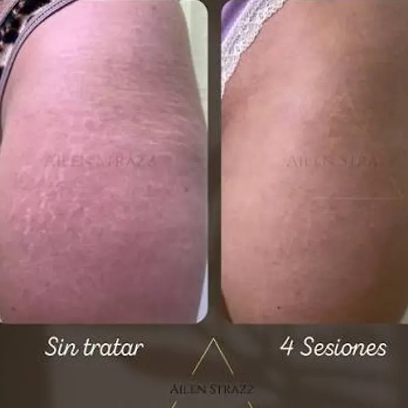 TRATAMIENTO DE ESTRÍAS EN MUSLOS 