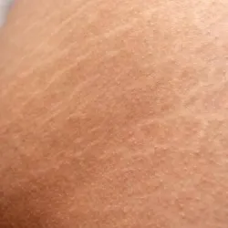 TRATAMIENTO DE ESTRÍAS EN SENOS