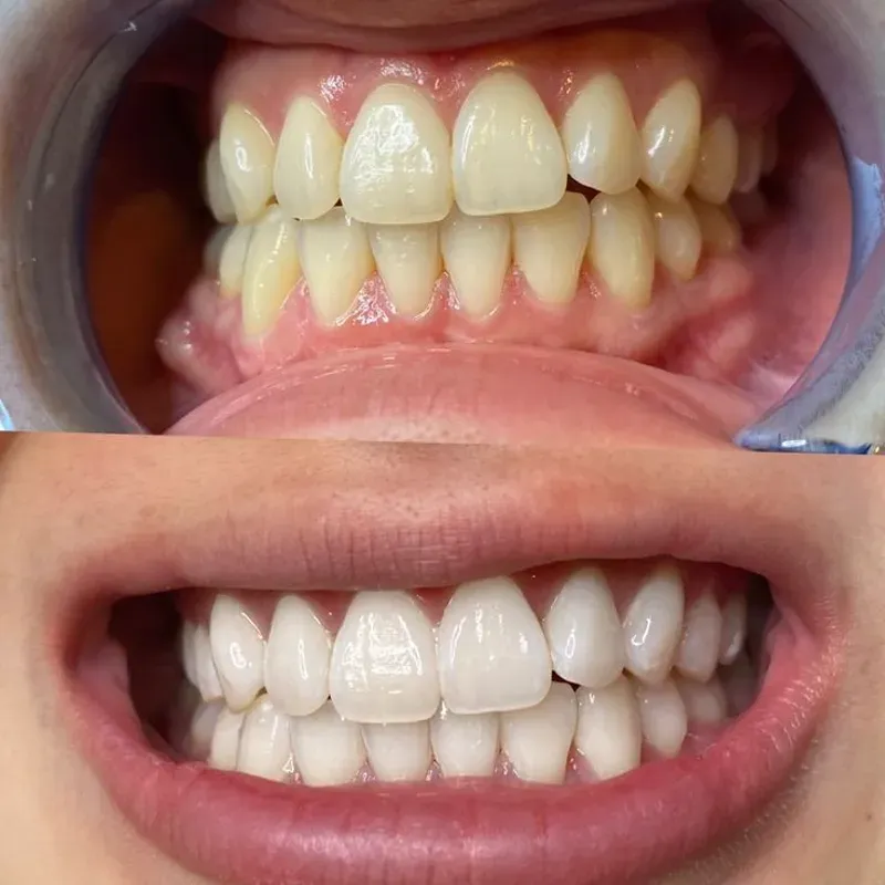 Blanqueamiento Dental Estetico