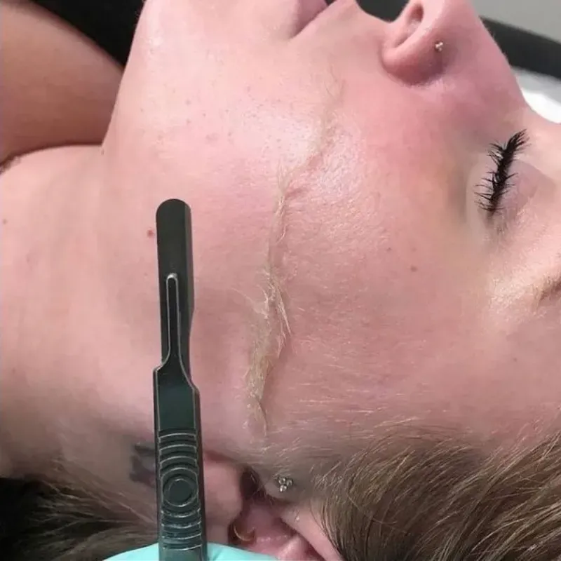 Dermaplaning