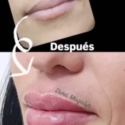 Ácido hialurónico Aumento de labios y armonizacion facial.